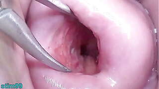 Japanese Wife Open Cervix Wide to watch inside Uterus